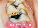 虫歯治療 虫歯治療