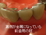 前歯用クラウン 前歯用クラウン