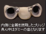 メタルボンド・ブリッジ メタルボンド・ブリッジ