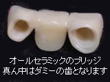 オールセラミック・ブリッジ オールセラミック・ブリッジ